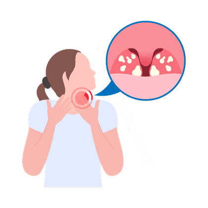 Angina und Mandelentzündung