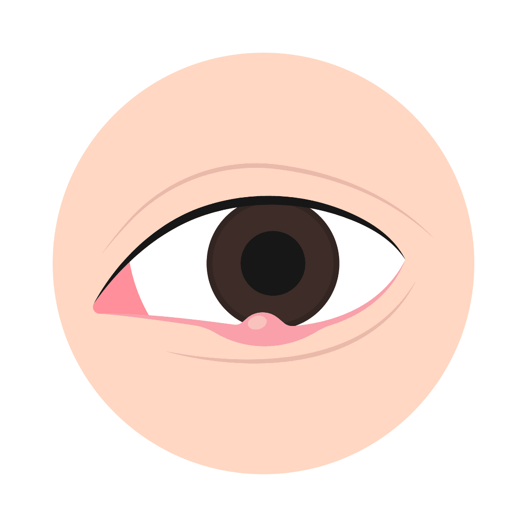 Gerste (hordeolum)